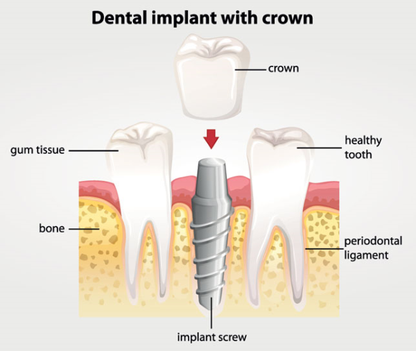 Planting Permanent Porcelain Teeth At Home Dental