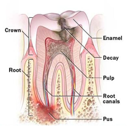 ROOT CANAL TREATMENT