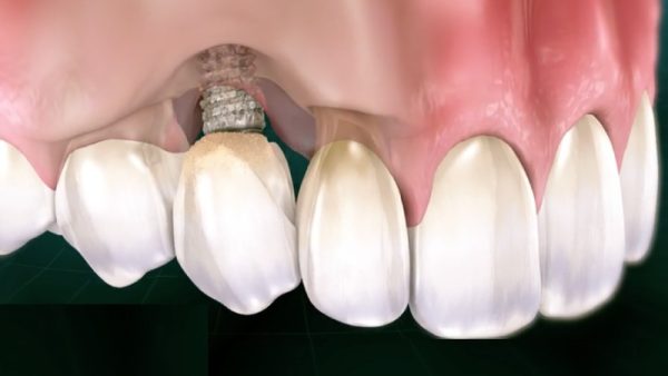 Inflammation around the implant post