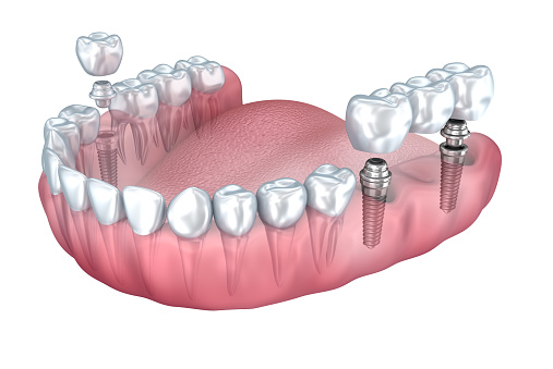 Does implant placement improve the condition of tooth wear?