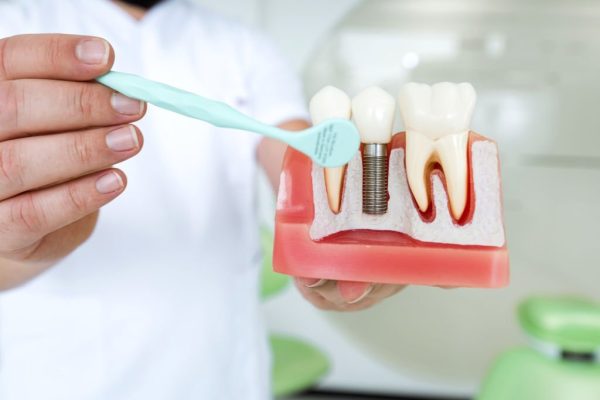 How long does it take to recover from a dental implant?
