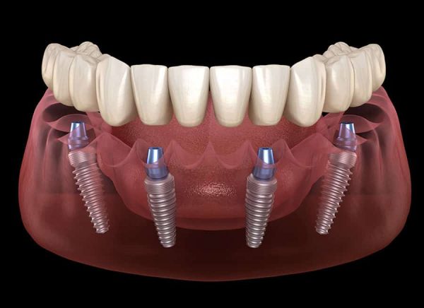 How long does it take to recover from a dental implant?