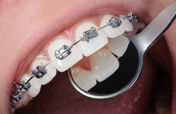 Should braces first or implant teeth first?