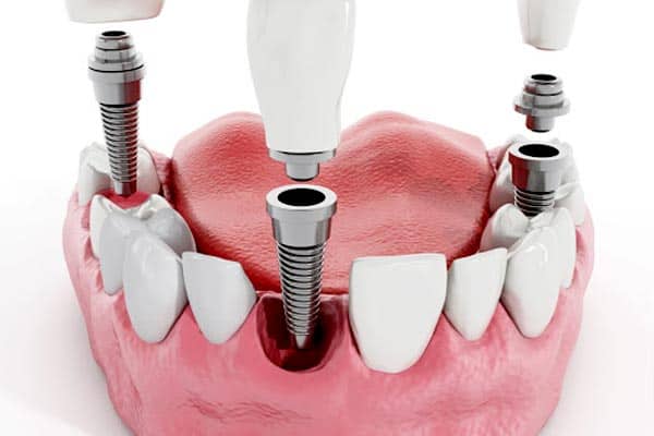 Does Dental Implant have bad breath?