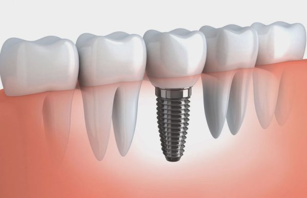 Dentium USA is a popular implant post known for its six outstanding features: durability, long lifespan, rapid integration, bone resorption prevention, versatility in various cases. 1. Basic information about Dentium USA Implant post First, the dentist will provide customers with basic information about this famous implant post line. Origin: Dentium Implant is a line of implants that are researched and manufactured by Dentium Co, Ltd - USA. This is a well-known manufacturer of dental implant and grafting systems in over 80 countries worldwide. Currently, the company's manufacturing facilities are located in South Korea and the United States. They are ISO 13485 certified. Implant Dentium is the leading brand in the market for affordable implant lines in the Asian region and worldwide. Structure and design: Implant Dentium is made from 100% pure titanium. Titanium is an extremely biocompatible material widely used in dentistry, such as braces and porcelain veneers. The implant consists of 3 parts: the implant post (which is implanted into the jawbone), the abutment (connecting joint), and finally the ceramic tooth crown. The implant is designed with a small diameter and a slender shape to evenly distribute force on all surfaces. Especially on the implant post, there are dual grooves that help accelerate the integration process with the jawbone, shortening the time for tooth transplantation. How long does it take to implant Dentium from the US? The integration period of this type of implant ranges from 3 to 6 months. The integration time with the jawbone also depends on the customer's body condition and post-treatment care. Some people have a fast integration process within just 1 month. Expert evaluation: Dentium Implant from the US is not the highest-end type of implant. However, it is widely favored for its durability and biocompatibility. This implant can be applied in all cases of missing teeth, such as missing incisors, molars, or even the entire jaw. 2. American Dentium Implant post and outstanding advantages Fast integration with jawbone In addition to its optimized design, the Dentium Implant also features a biological coating called TiUnite, which helps accelerate the process of tissue bonding with the implant. Versatile application The Dentium implant is indicated for cases such as single tooth loss, multiple tooth loss, and full arch rehabilitation. The implant comes in various lengths and diameters to fit different jawbone regions. Prevention of jawbone resorption Dentium Implant prevents the process of jawbone resorption. After 3 months of tooth loss, the sockets of the teeth and gums tend to collapse, leading to a loss of nerve fibers. If not treated in a timely manner, these sockets can become a place for food debris and create bacterial infections that cause periodontitis, bad breath, and other complications. Relatively long lifespan Dentium Implant post can be used for a lifetime if performed by a highly skilled doctor and the correct genuine post is chosen. In addition, customers also need to care for their oral hygiene as directed to ensure long-term post protection. Firm and good for chewing force Dentium Implant post has a very low rate of rejection. The titanium material is highly compatible with the body, resulting in a high integration rate of up to 99%. Customers do not need to worry much about post rejection, which can cause mouth inflammation. This type of post is also very firm, so it has good chewing ability. After implanting the teeth, the post can help customers eat and taste food as if they had natural teeth. Reasonable price Dentium Implant is priced at a mid-range level. It is suitable for many customers from students, new employees to middle-aged people. Its good quality is comparable to expensive post brands from Germany, Sweden, and France. 3. Choose a reputable address to safely implant Dentium Implants Although Implant Dentium USA is considered a good choice, the success of the procedure largely depends on the place where the implant is placed. To ensure a fast and safe Implant Dentium USA procedure, customers should choose the most reputable treatment center, specifically one that: • Has a team of highly specialized and experienced doctors. • Possesses modern and advanced facilities with full amenities. • Provides post-service care to customers. Customers can search for information on social media platforms such as websites, Facebook, YouTube, and groups to learn more. Or they can visit the clinic directly to experience the consultation services and see the facilities. Home Dental is a dental clinic chain built according to German standards and is the first in Vietnam. It is also among the top most reputable dental clinics up to date. Why Home Dental is chosen by many customers? We are advised by top-notch dentists, masters, and professors in dentistry around the world. Notably: Dr. Nguyen Anh Ngoc Dr. Nguyen Anh Ngoc is a Master's degree holder and a dentist who has participated in many specialized dental training courses in advanced dentistry in European countries. With his vast experience, Dr. Ngoc has collaborated with a team of dentists at Home Dental - 30 Trieu Viet Vuong to build a dental clinic that not only meets German standards in terms of equipment but also in terms of human resources and treatment methods. His achievements include: • Graduated top of his class with distinction in Dentistry from Hamburg University • Awarded one of the 13 outstanding Vietnamese individuals in Germany by the Consul General of Vietnam in Germany. • Awarded one of the 10 outstanding students in Germany in 2013 • A member of the Hamburg and Schleswing Holstein and Hamburg Doctor Association. • Representative (KOL) of Implant Dentium and TioLogic in Vietnam. • Taught surgery and implant techniques to dentists in Hanoi and Saigon • Successfully carried out tens of thousands of implant treatments, surgeries, and cosmetic dental procedures, all resulting in satisfied customers. • All customers are satisfied with the services provided by Home Dental. Furthermore, Home Dental always focuses on updating and equipping the most advanced dental equipment in the world to Vietnam. Our team of dentists uses modern machinery such as Cone Beam CT imaging machines, centrifugal casting machines, CAD/CAM ceramic tooth processing machines, and implant simulation software to ensure safe and effective implant procedures with Implant Dentium USA. All implant lines at Home Dental are imported directly from the United States with genuine labels and clear specifications. Our dentists understand the importance of the sterilization process, and our clients are treated in a sterile environment to prevent bacteria from invading and causing infections during the surgical procedure. Clients can rest assured that every treatment at Home Dental is performed with the utmost safety and guaranteed tooth longevity. In addition, our clinic offers a variety of post-treatment care policies and incentives. Implanting teeth using implant dentistry is a complex dental technique. If not done properly, it can leave undesirable effects in the oral cavity. To ensure safety, clients should consult with dentists at Home Dental for a thorough check-up and treatment with Implant Dentium USA. 