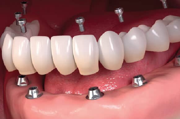 Important experience when implanting teeth