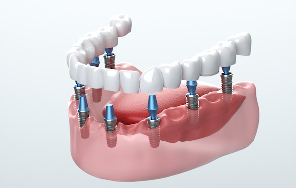 Should braces first or implant teeth first?