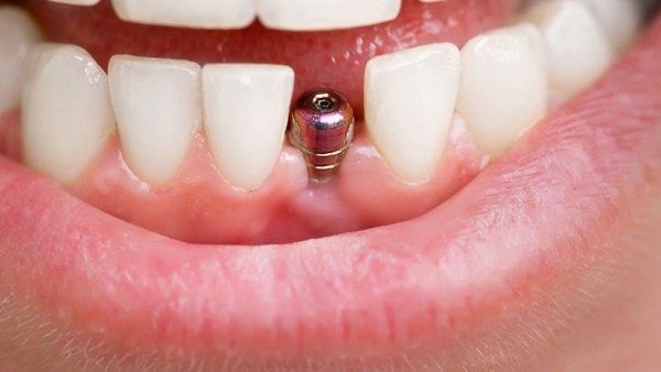How Long Is The Lifespan Of Dental Implants? Answered By Home Dental Dentist 