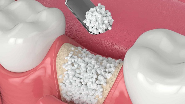 Is the bone grafting method for dental implants painful?