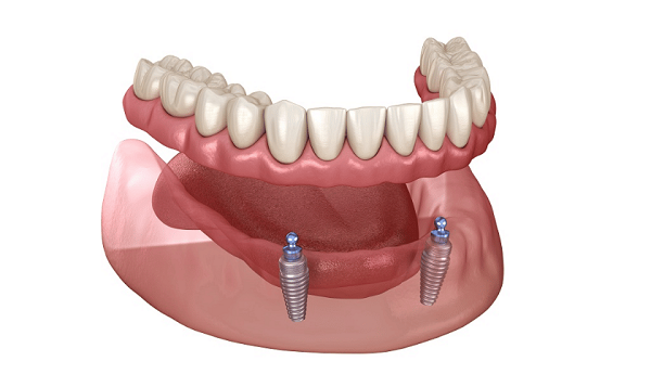 All about Mini Dental Implant you need to know