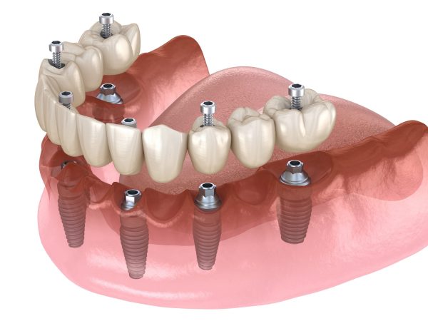 Does implant placement improve the condition of tooth wear?