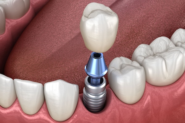 Does Dental Implant have bad breath?