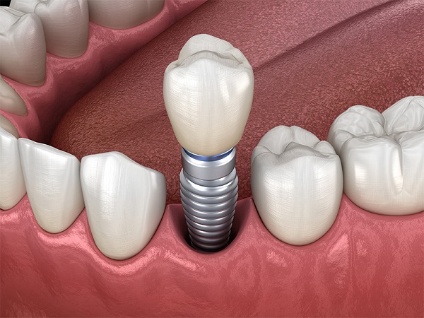 Important experience when implanting teeth