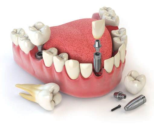 All about Mini Dental Implant you need to know