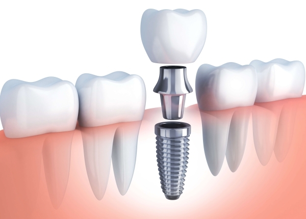 4 factors that affect the size of implant abutments you should know about.