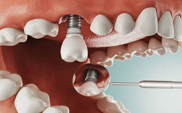 Common side effects of Dental Implant surgery