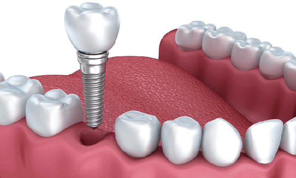 Criteria for choosing a Dental Implant address