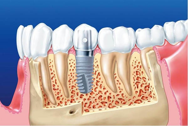 Advantages of Dental Implant