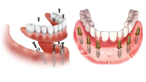 Dental Implants improve chewing function