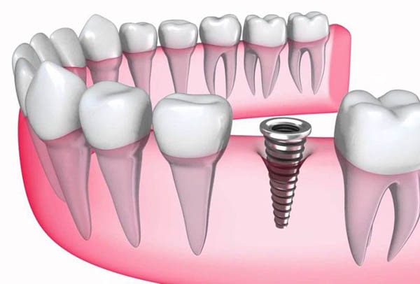 What Dental Implant brand to choose?