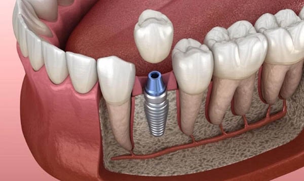 Inappropriate care after implantation