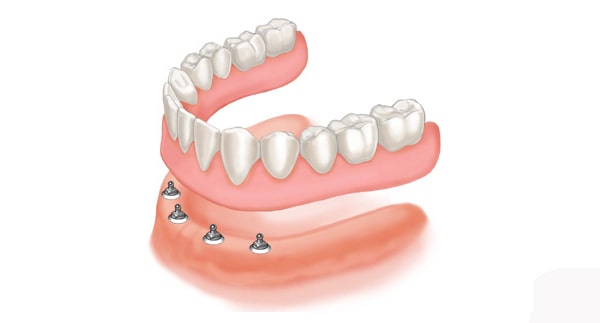 What is Mini Dental Implant surgery?
