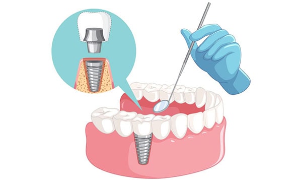 The procedure of Dental Implant method