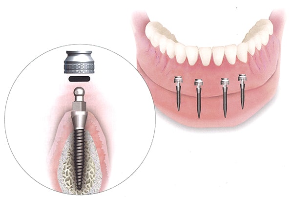 The process of Mini Dental Implant surgery