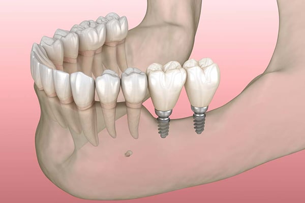 What are the advantages and disadvantages of Mini Dental Implant