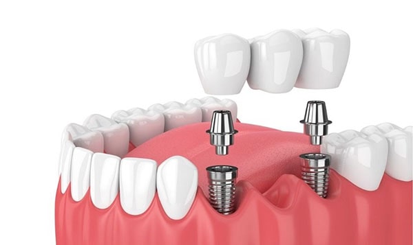 How long does it take each stage of dental implant?