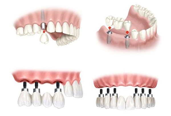 Conditions for Implant teeth