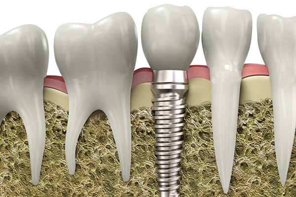 What is a Dental Implant