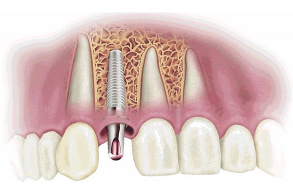 Is dental implant dangerous