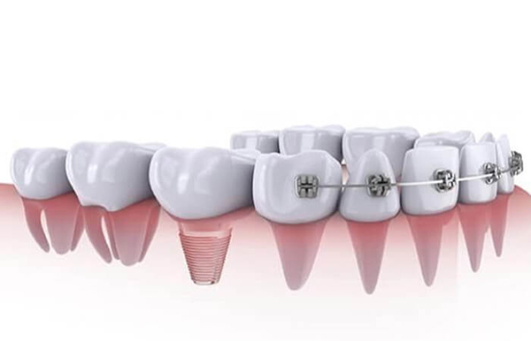 Mechanism of Dental Implants and braces