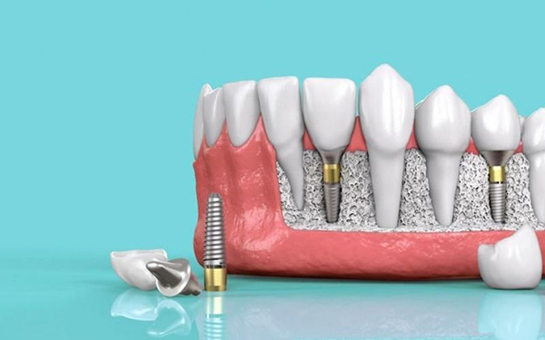 Prevent bone loss, receding gums