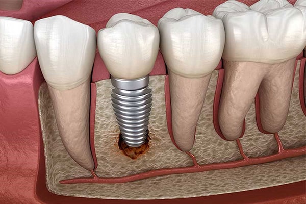 Note when taking MRI for people who have Implanted teeth