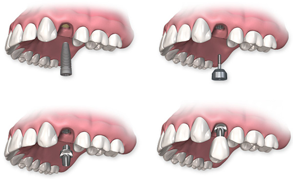 The dental implant procedure includes
