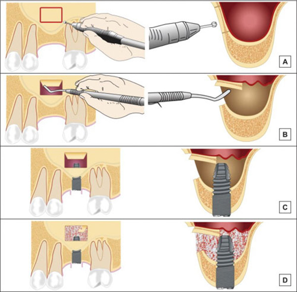 What is the Sinus Lift before placing the Dental Implant