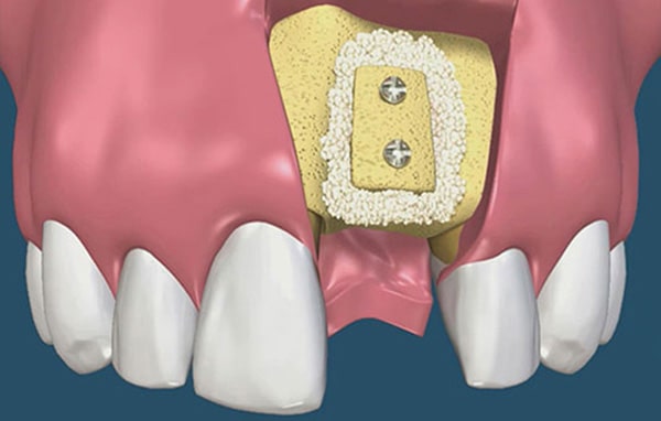 What is Dental Bone Grafting