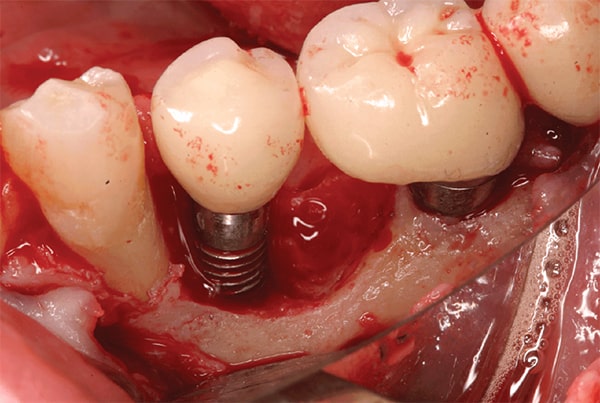 Is it painful to perform a dental implant
