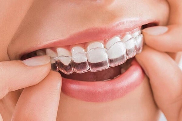 Braces for misaligned front teeth with transparent trays
