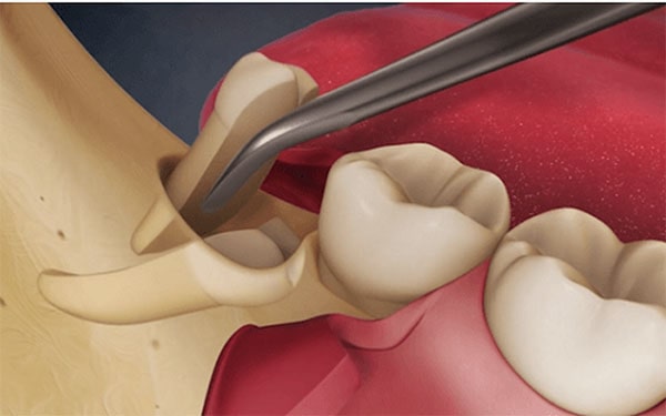 Complications when extracting upper wisdom teeth