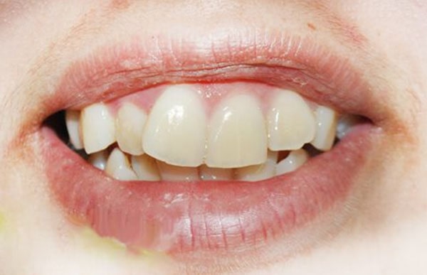 Inclined front teeth