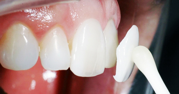 Is it painful to get Porcelain Veneers? Cost, Process and Lifespan