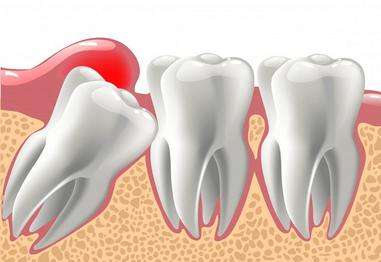 Signs of misaligned wisdom teeth that need to be removed immediately