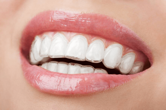 Prestigious Invisalign Clear Aligners addresses in Hanoi