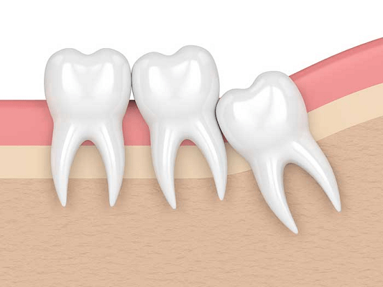 Types of misaligned wisdom teeth and how to safely remove them
