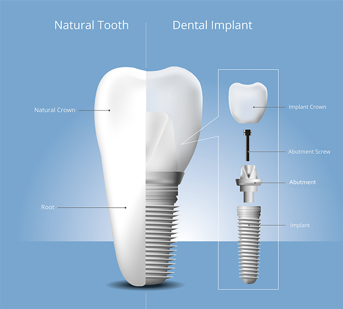 Is the Swiss Straumann Implant Good? Features and Cost
