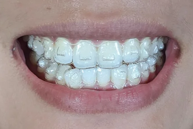 The best address for Invisalign Clear Aligners in Hanoi 2023